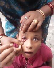 Girl Eye Stone Tears: Strange poor case… instead of tears in the eye, stones came out… see VIDEO