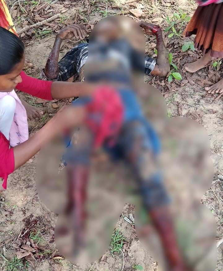 IED Blast In Bijapur: Villager's leg badly damaged after being hit by pressure IED in Bijapur... see here