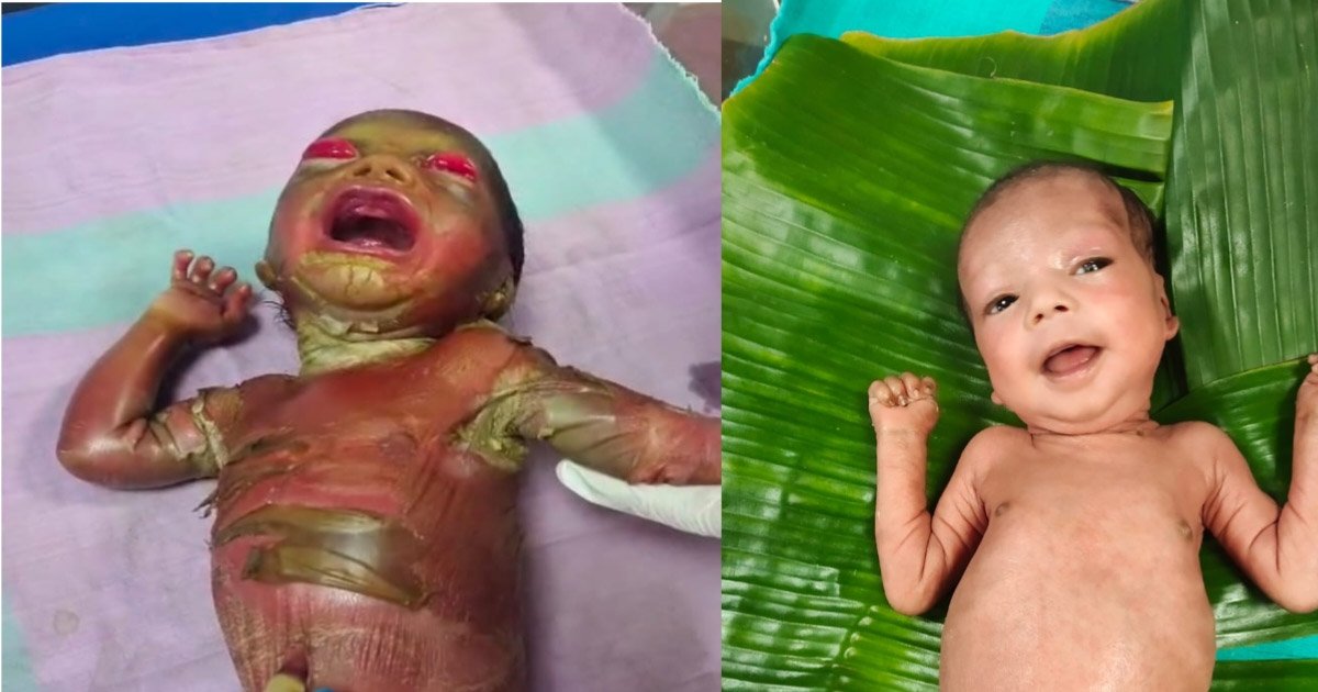 बीजापुर अस्पताल में चमत्कार जैसा इलाज…दुर्लभ बीमारी से जूझ रहे नवजात को मिला नया जीवनबीजापुर अस्पताल में चमत्कार जैसा इलाज…दुर्लभ बीमारी से जूझ रहे नवजात को मिला नया जीवन